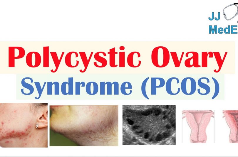 Top 8 reasons to adopt a low-carb diet for polycystic ovary syndrome