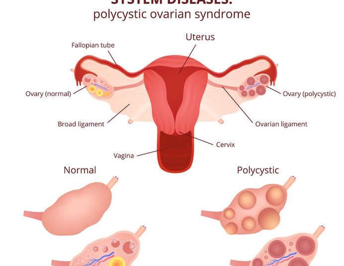 How to potentially reverse PCOS with low carb