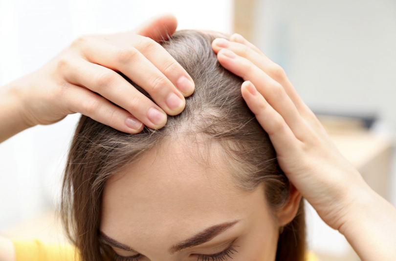 How to Prevent Hair Loss with a Ketogenic Diet